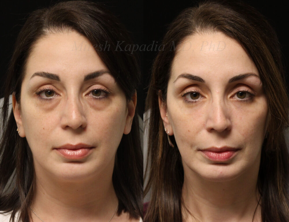 Lower Eyelid Surgery in Vietnam: Reduce Puffiness and Eye Aging 3 Lower Eyelid Surgery in Vietnam: Reduce Puffiness and Eye Aging