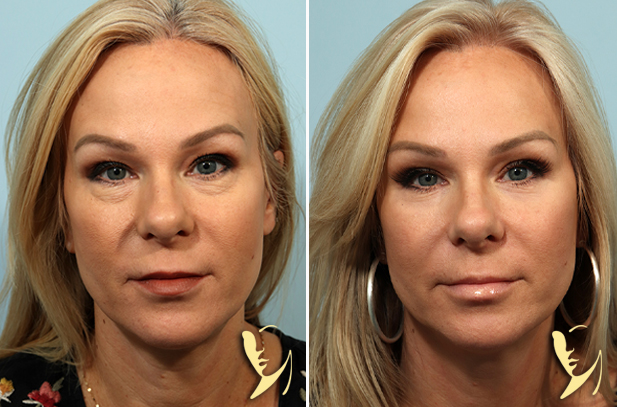 Lower Eyelid Surgery in Vietnam: Reduce Puffiness and Eye Aging 5 Lower Eyelid Surgery in Vietnam 3