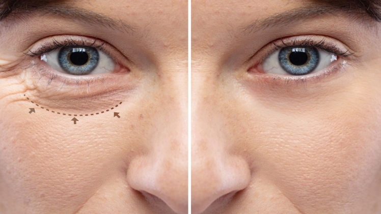 Lower Eyelid Surgery in Vietnam: Reduce Puffiness and Eye Aging 6 Lower Eyelid Surgery in Vietnam 4