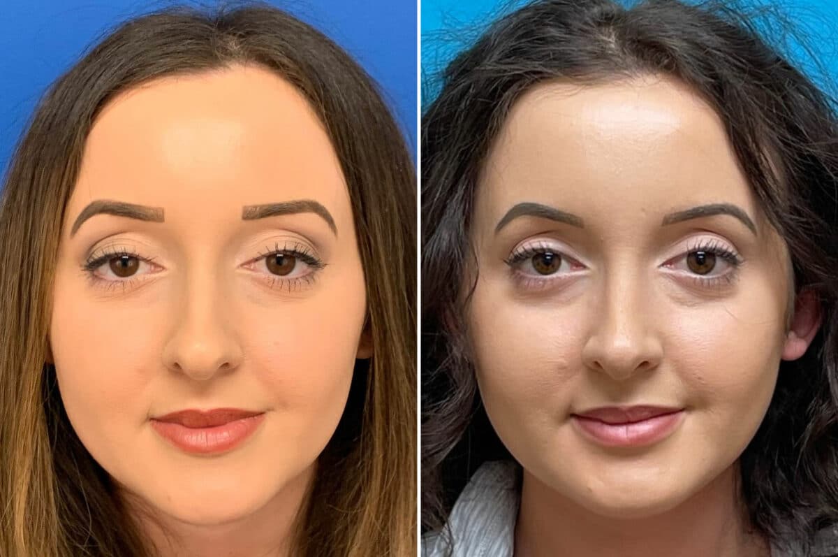 Nasal Tip Refinement in Vietnam: Enhance Definition and Facial Balance 5 Nasal Tip Refinement in Vietnam 3