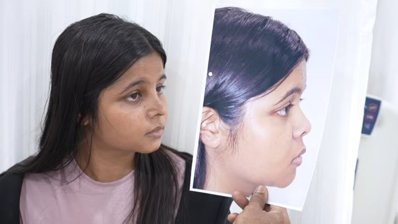 Nasal Tip Refinement in Vietnam: Enhance Definition and Facial Balance 7 Nasal Tip Refinement in Vietnam 5