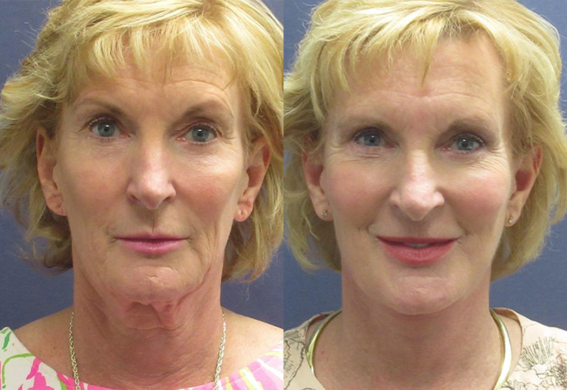 Neck Lift Surgery in Vietnam: Restore a Firm and Youthful Neckline 3 Neck Lift Surgery in Vietnam: Restore a Firm and Youthful Neckline