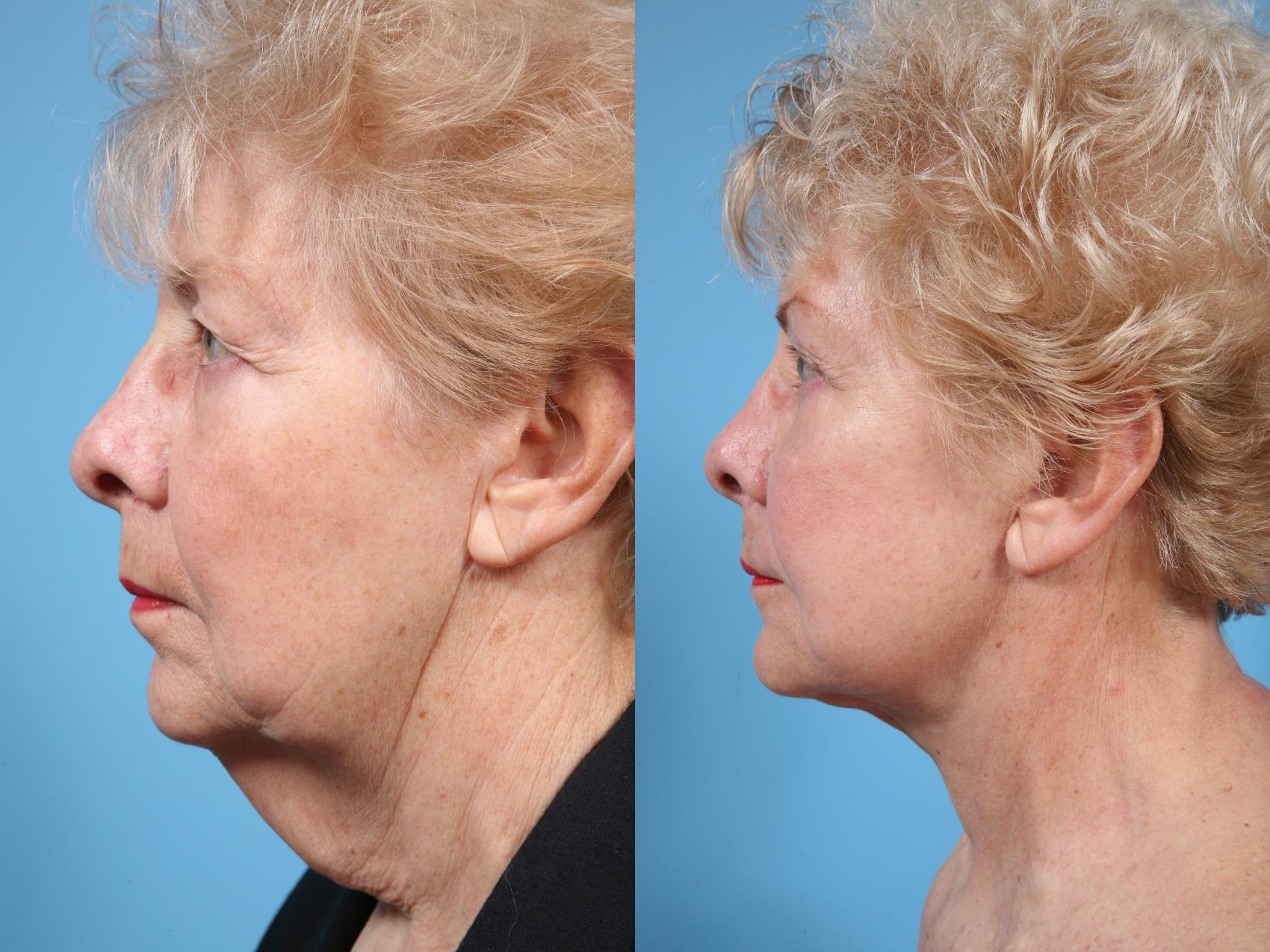 Neck Lift Surgery in Vietnam: Restore a Firm and Youthful Neckline 4 Neck Lift Surgery in Vietnam 2