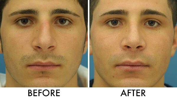 Non Surgical Nose Correction in Vietnam: Enhance Nose Shape Without Surgery 4 Non Surgical Nose Correction in Vietnam 2