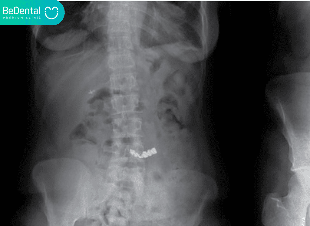 Vô tình nuốt răng thật vào bụng có sao không và cách xử lý an toàn? 3 Nuốt răng thật vào bụng có sao không