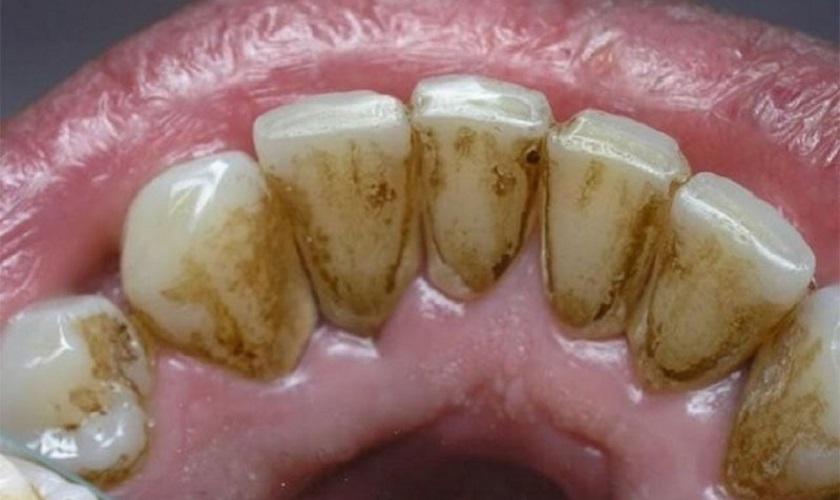 Smoking And Effects Of Smoking During Braces