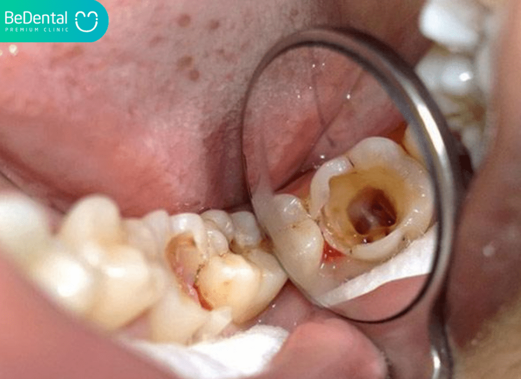 Răng bị lủng lỗ đau nhức: Nguyên nhân, biến chứng và cách điều trị hiệu quả 3 Răng bị lủng lỗ đau nhức