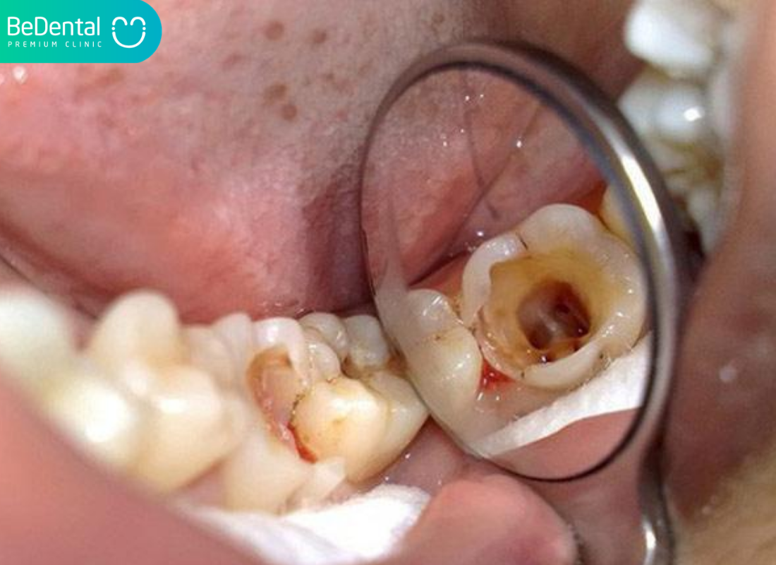 Răng bị lủng lỗ đau nhức