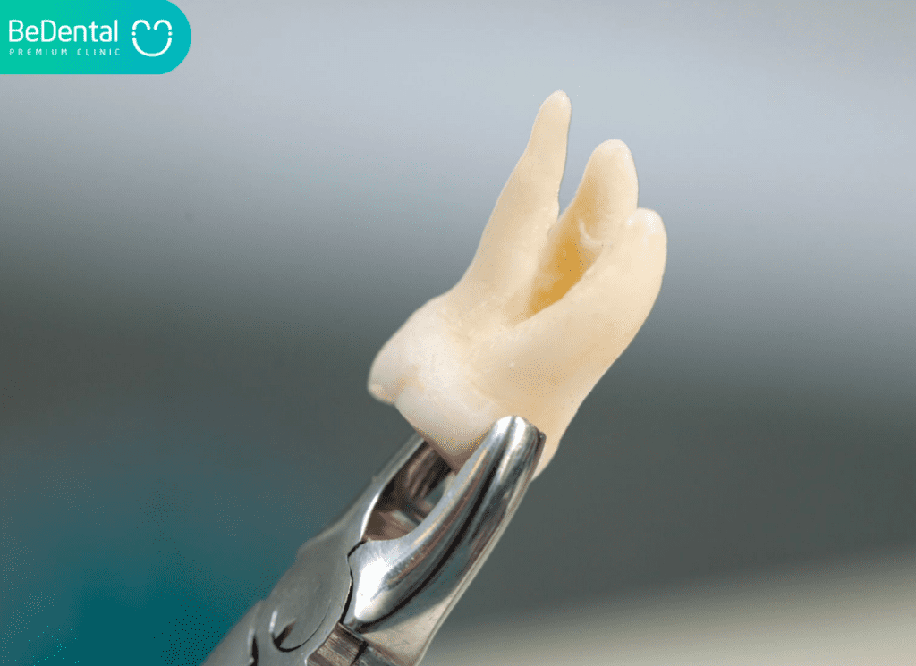 Răng khôn có mấy chân và những lưu ý quan trọng khi nhổ bỏ 3 Răng khôn có mấy chân