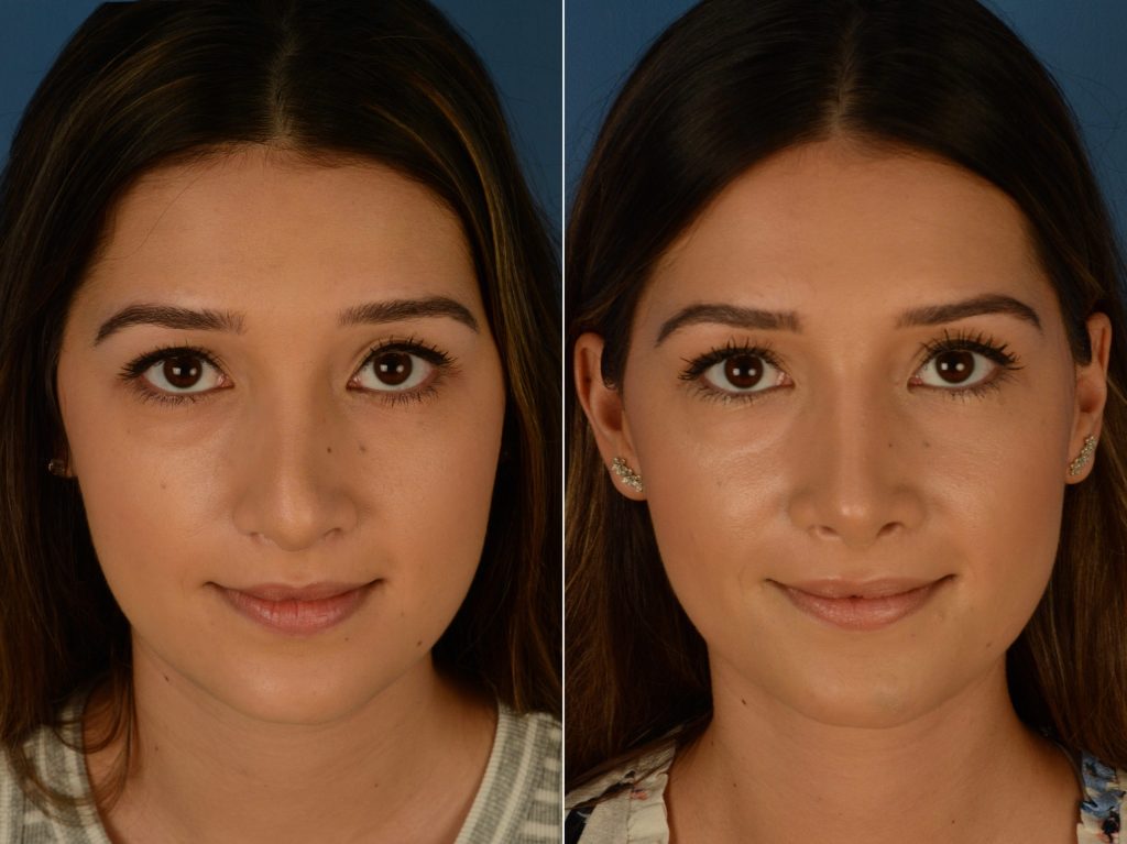 Revision Rhinoplasty in Vietnam 1