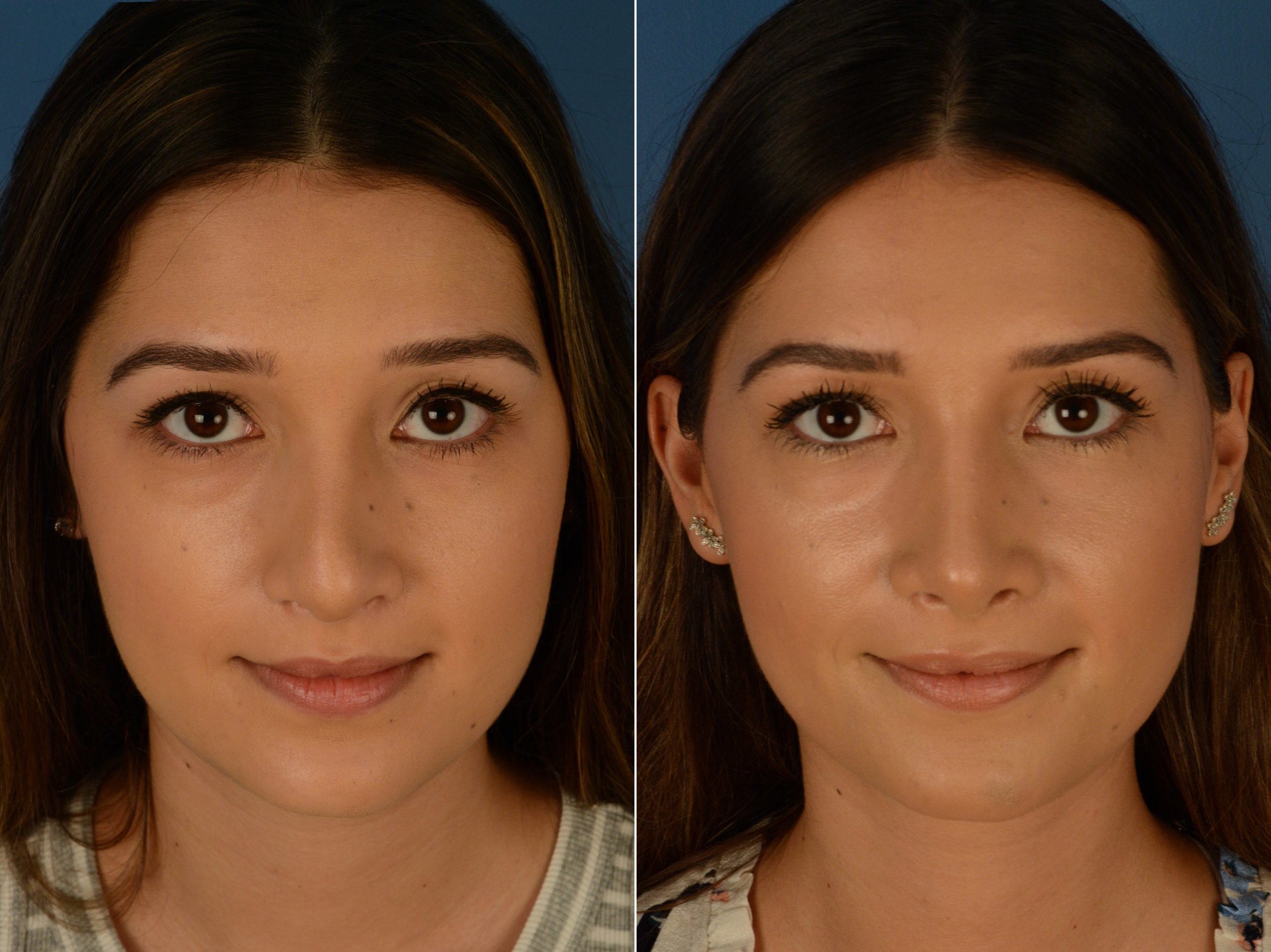 Revision Rhinoplasty in Vietnam: Correct and Refine Previous Nose Surgery 3 Revision Rhinoplasty in Vietnam: Correct and Refine Previous Nose Surgery