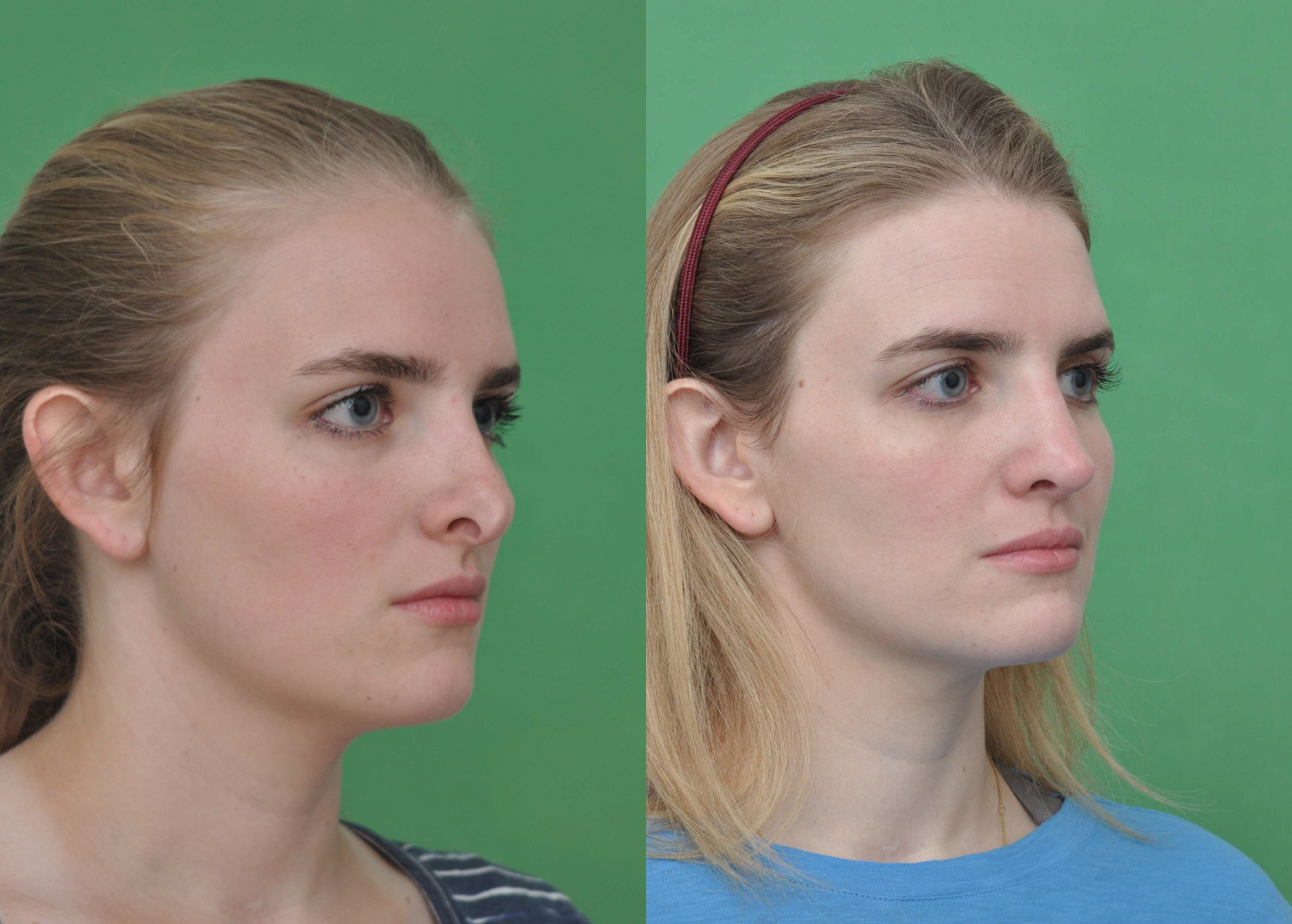 Revision Rhinoplasty in Vietnam: Correct and Refine Previous Nose Surgery 4 Revision Rhinoplasty in Vietnam 2