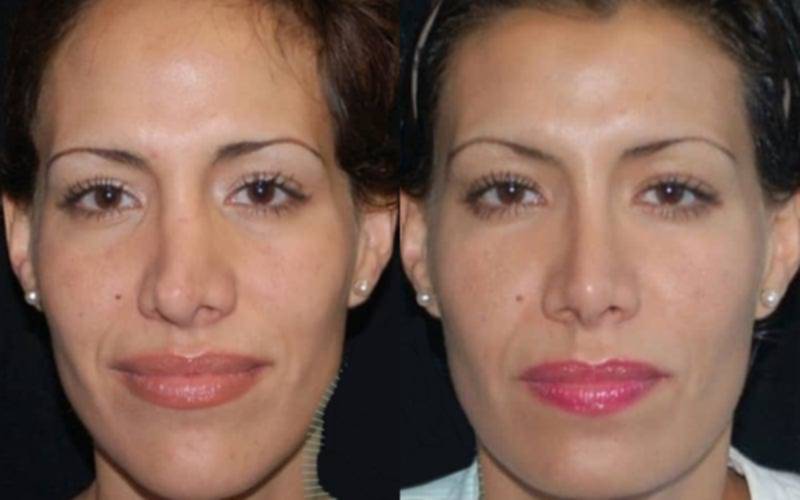 Revision Rhinoplasty in Vietnam: Correct and Refine Previous Nose Surgery 5 Revision Rhinoplasty in Vietnam 3