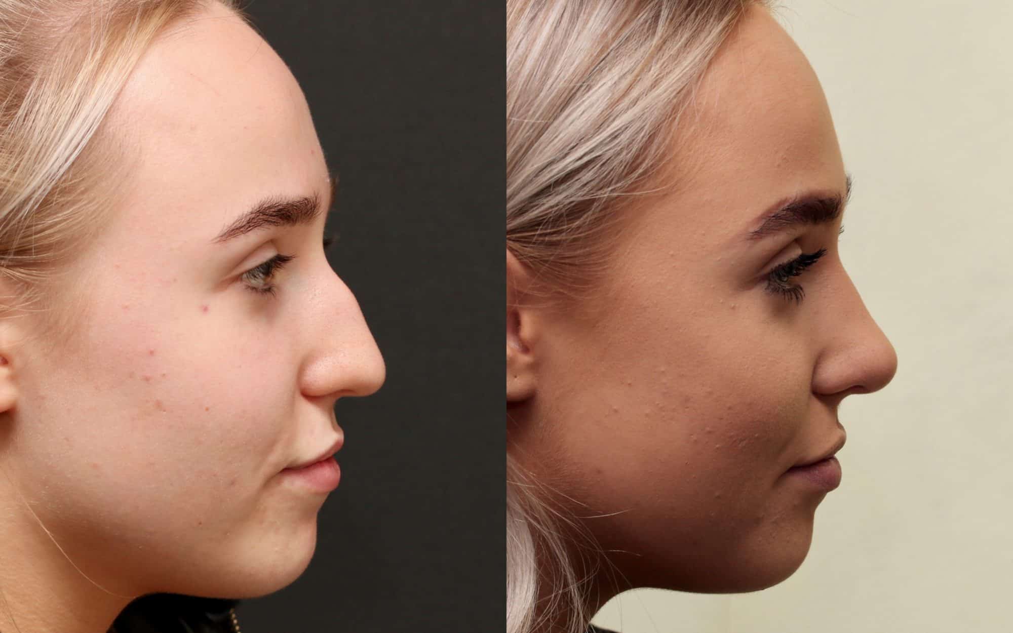 Rhinoplasty in Vietnam: Advanced Techniques for Natural-Looking Results 3 Rhinoplasty in vietnam 1