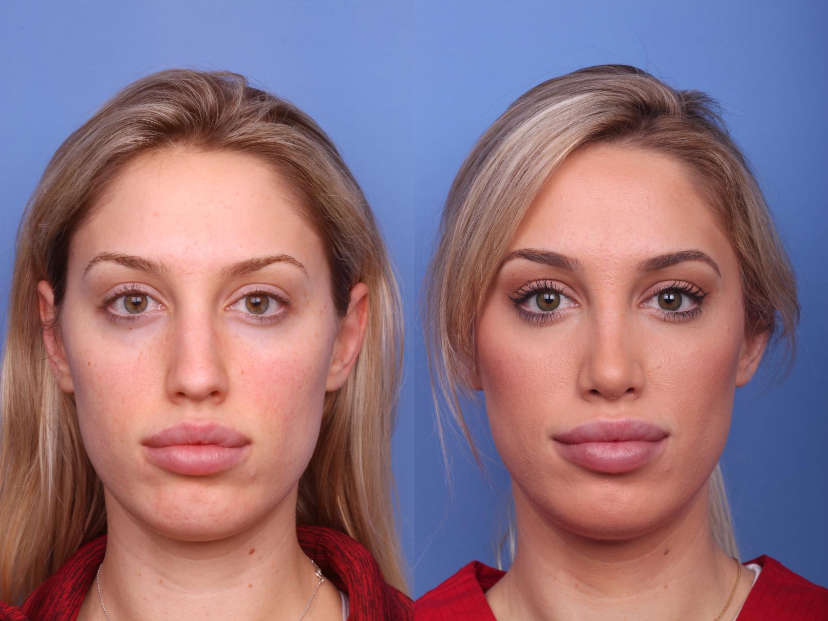 Rhinoplasty in Vietnam: Advanced Techniques for Natural-Looking Results 7 Rhinoplasty in vietnam 4