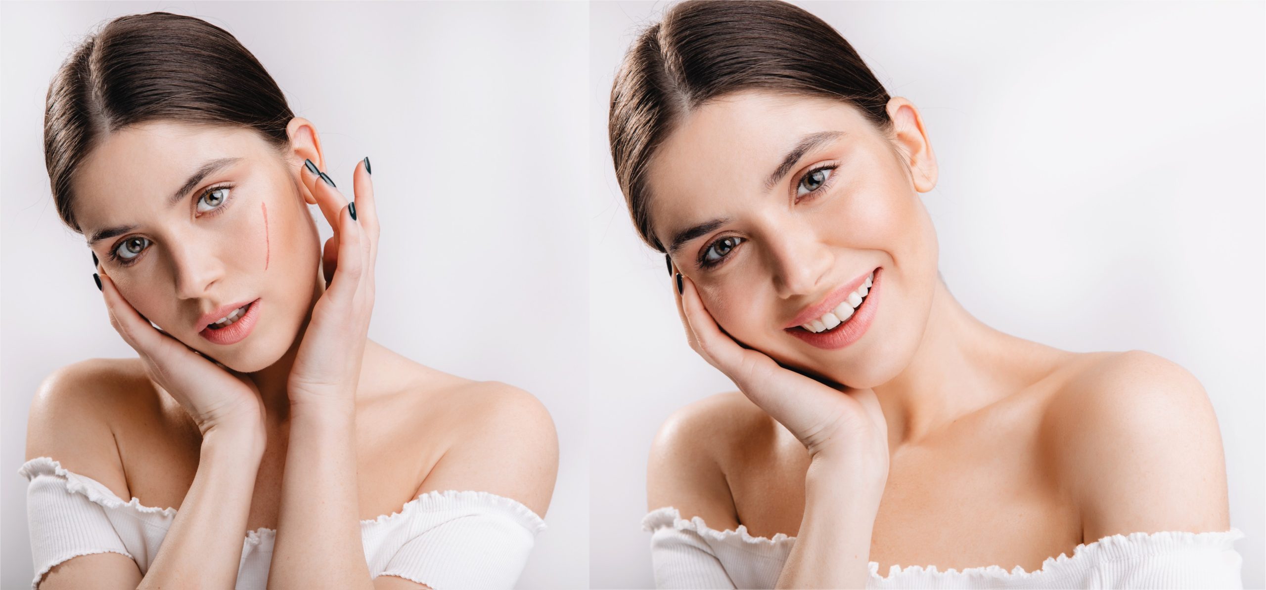 Scar Revision Surgery in Vietnam: Improve Scar Appearance Effectively 5 Scar Revision Surgery in Vietnam 3 scaled