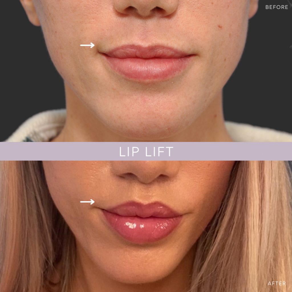 Smile Lip Lift in vietnam 1