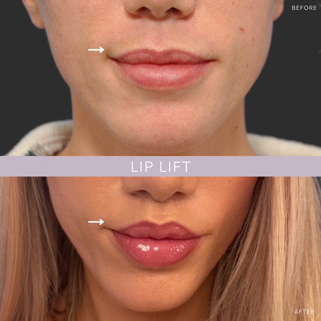 Lip Augmentation in Vietnam: Enhance Volume for Naturally Fuller Lips 4 Smile Lip Lift in vietnam 1