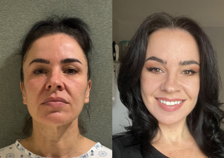 Temporal Lift in Vietnam: Lift the Upper Face for a Brighter Appearance 3 Temporal Lift in Vietnam: Lift the Upper Face for a Brighter Appearance