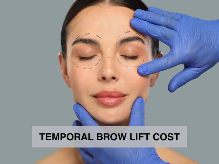 Temporal Lift in Vietnam: Lift the Upper Face for a Brighter Appearance 4 Temporal Lift in Vietnam 2