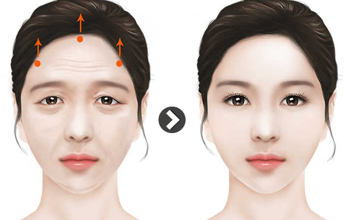 Temporal Lift in Vietnam: Lift the Upper Face for a Brighter Appearance 6 Temporal Lift in Vietnam 4