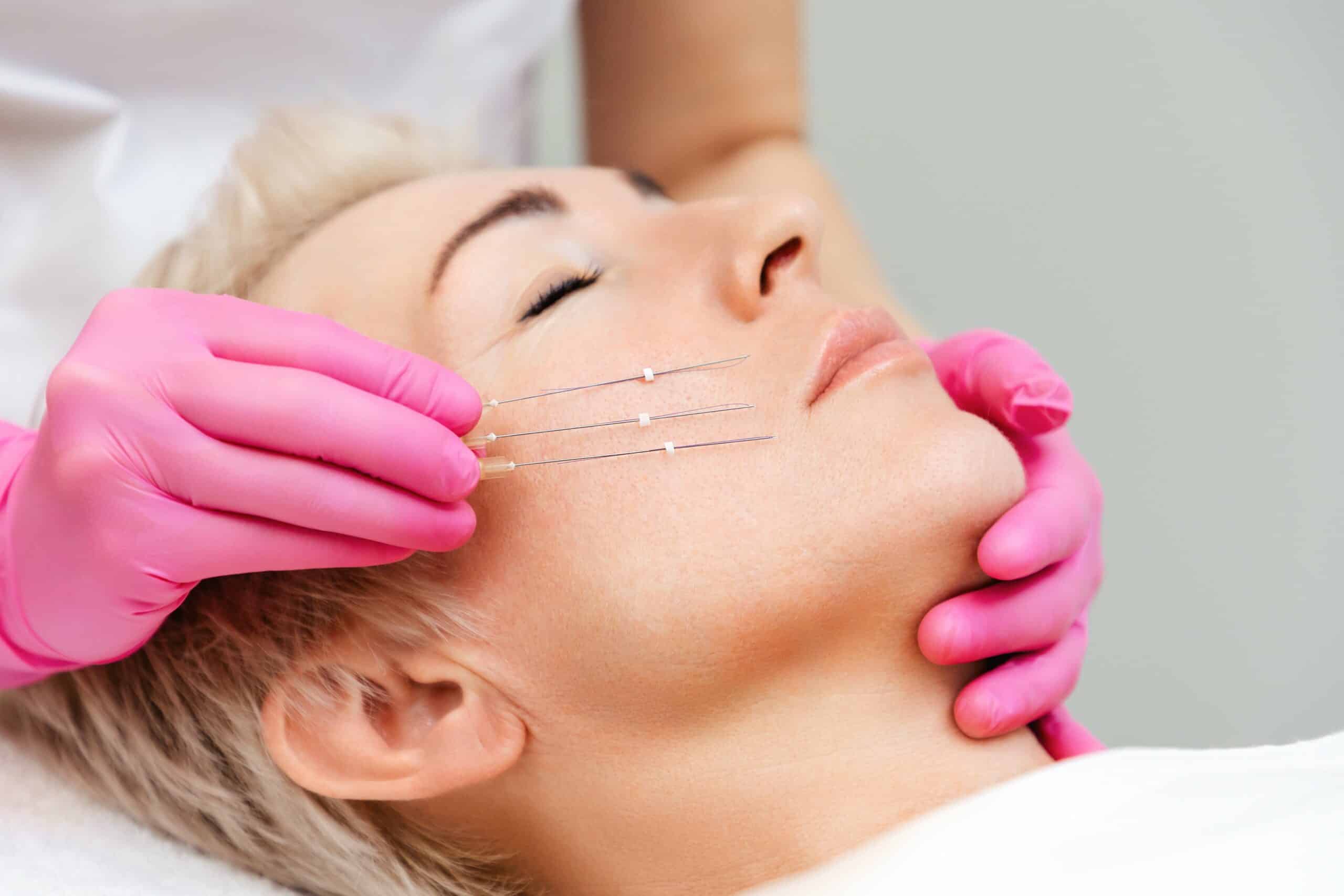 Thread Lift in Vietnam: Non-Surgical Facial Lifting with Immediate Results 3 Thread Lift in Vietnam: Non-Surgical Facial Lifting with Immediate Results