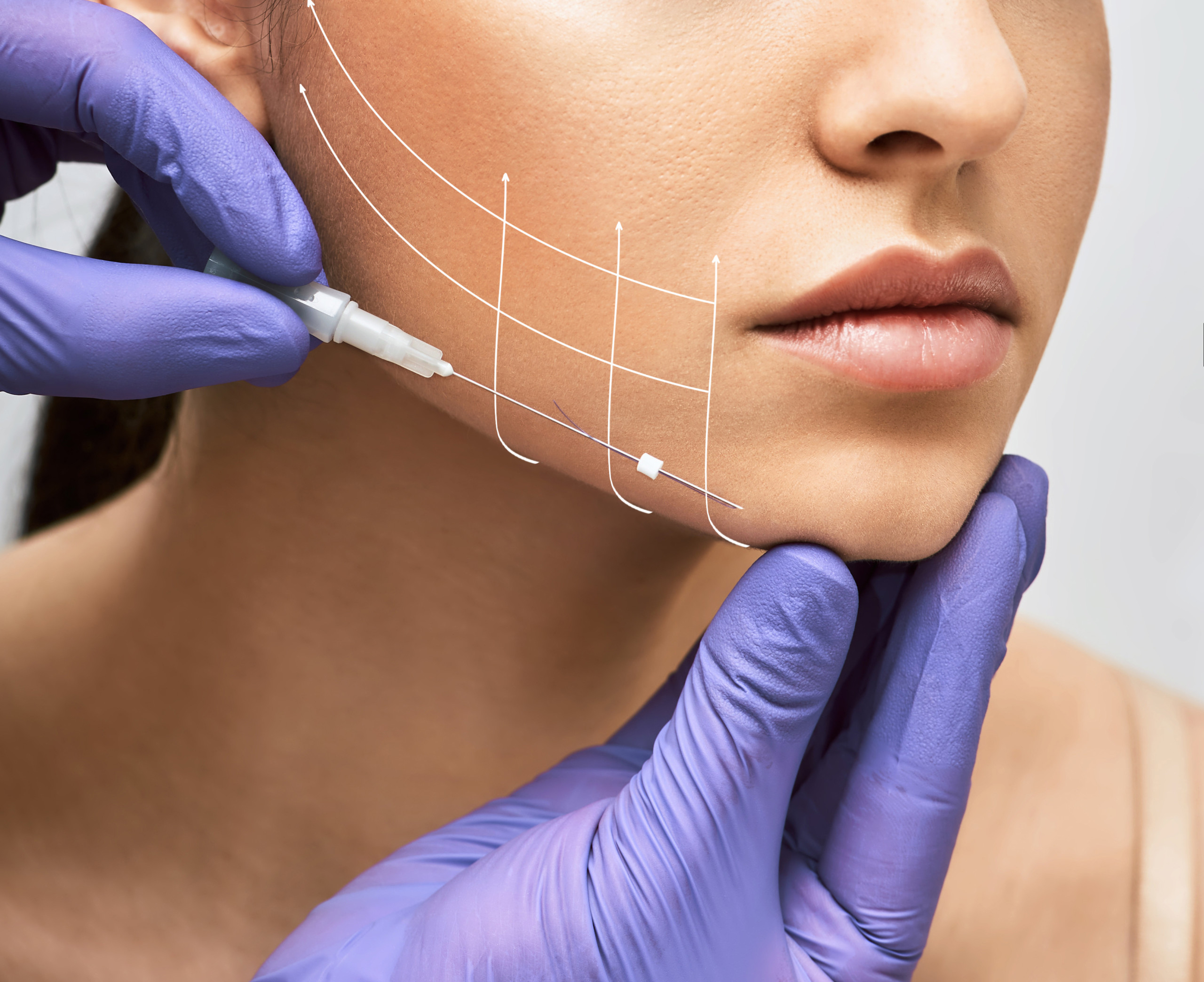 Thread Lift in Vietnam: Non-Surgical Facial Lifting with Immediate Results 5 Thread Lift in vietnam 3