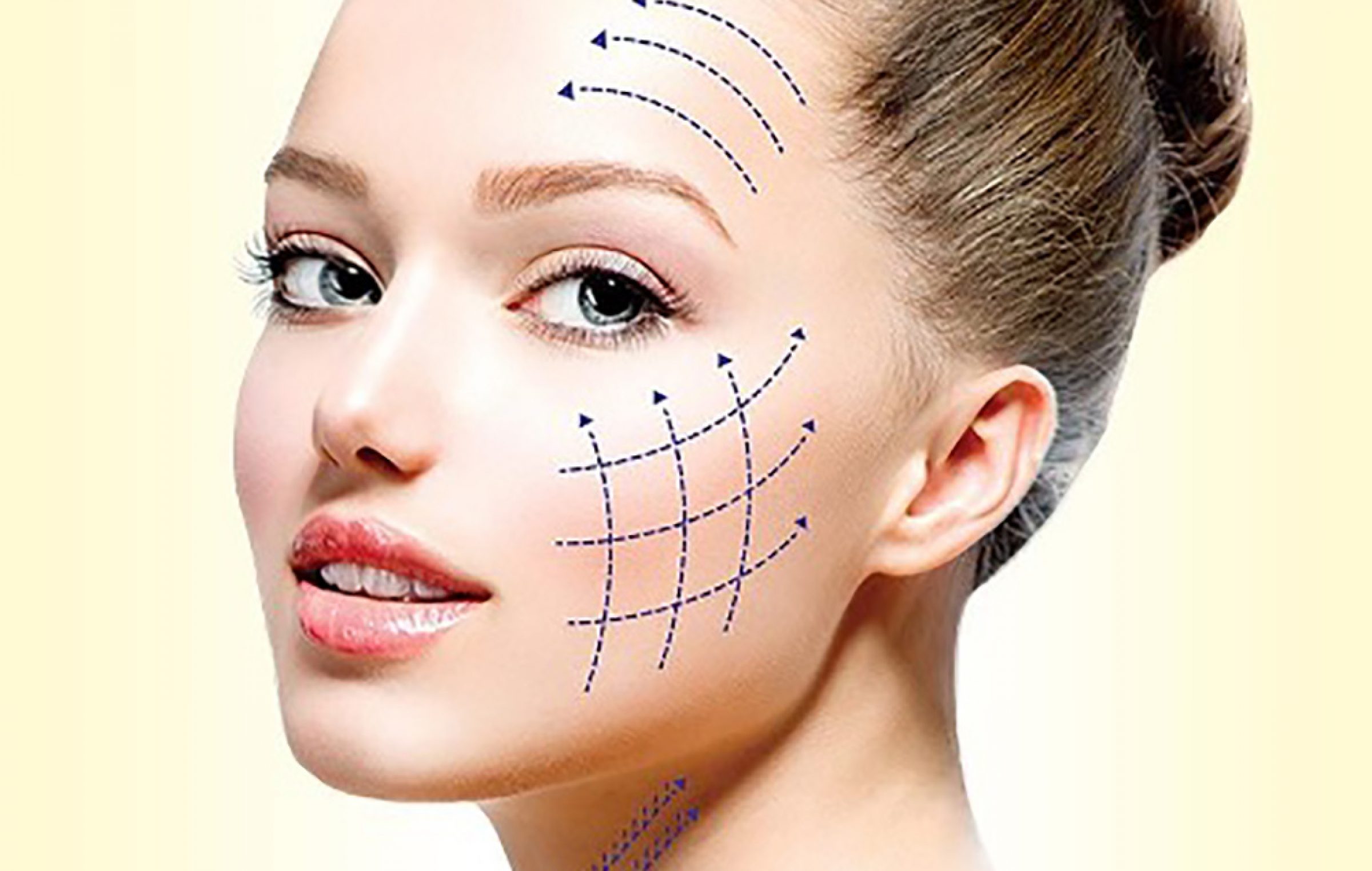 Thread Lift in Vietnam: Non-Surgical Facial Lifting with Immediate Results 6 Thread Lift in vietnam 4