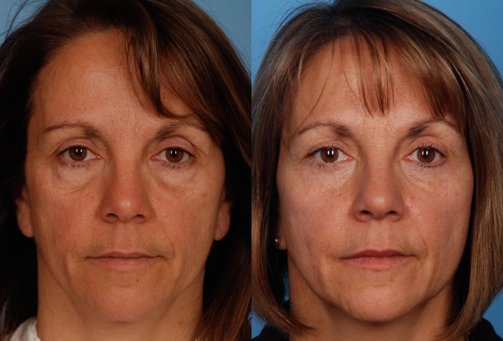 Upper Eyelid Surgery in Vietnam: Safe Solutions for a More Youthful Look 3 Upper Eyelid Surgery in Vietnam: Safe Solutions for a More Youthful Look