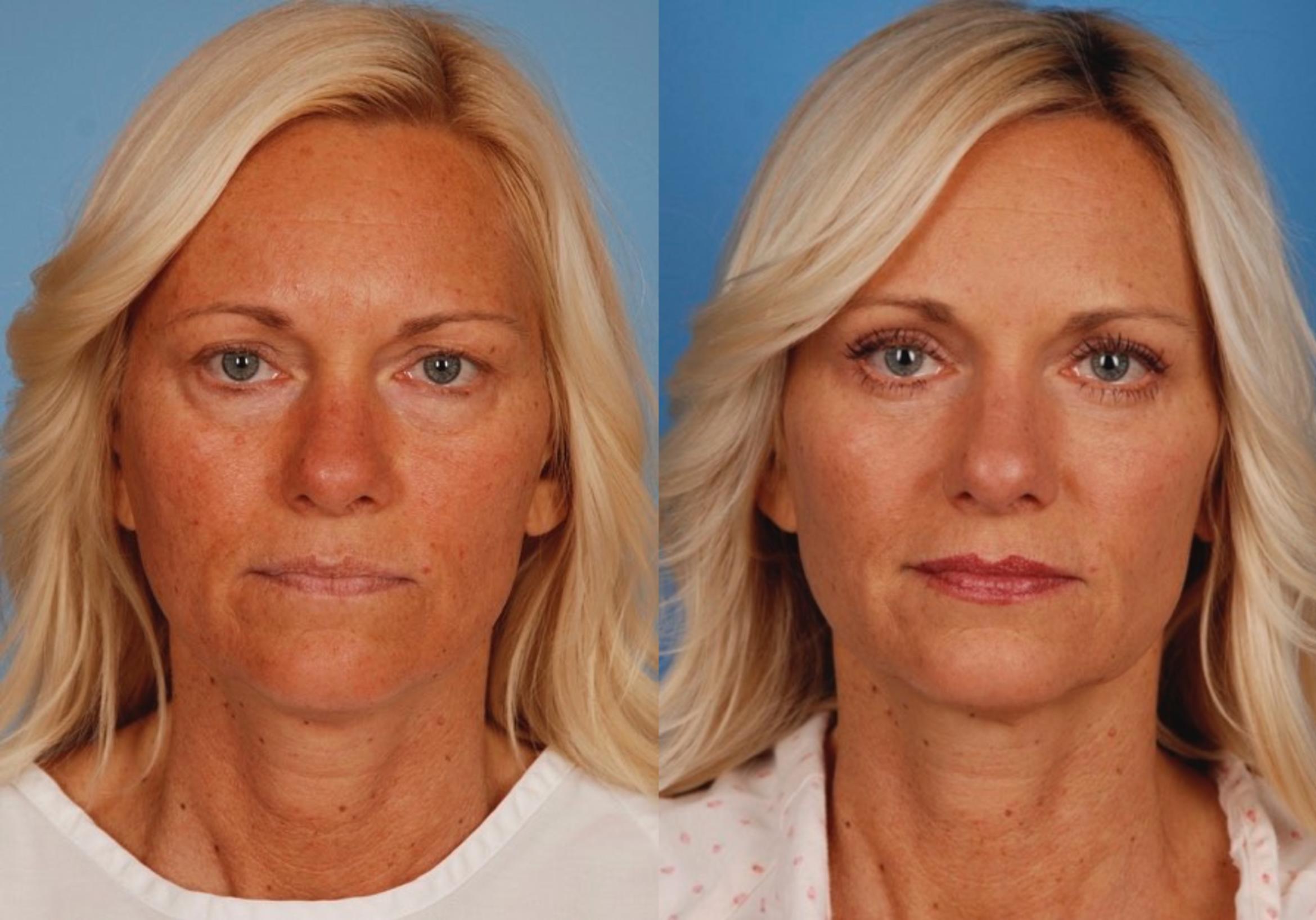 Upper Eyelid Surgery in Vietnam: Safe Solutions for a More Youthful Look 6 Upper Eyelid Surgery in Vietnam 2