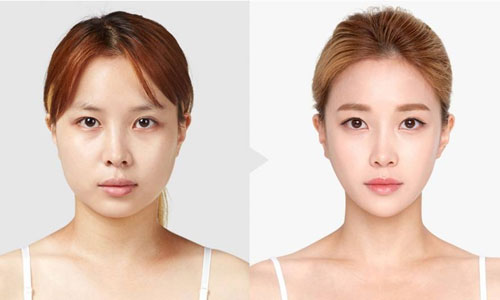 V Line Chin Contouring in Vietnam: Sculpt a Slim and Elegant Jawline 5 V Line Chin Contouring in vietnam 3