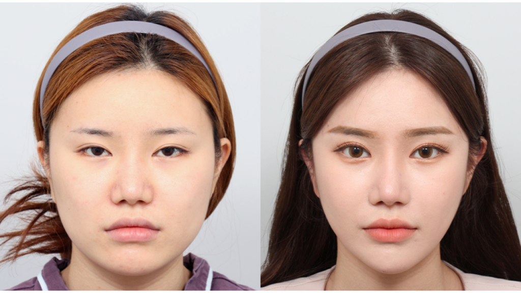 V Line Chin Contouring in Vietnam: Sculpt a Slim and Elegant Jawline 6 V Line Chin Contouring in vietnam 3