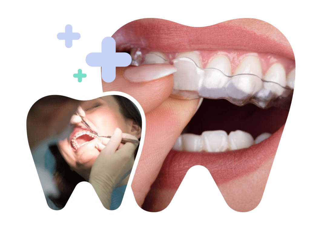 Clear Braces in Vietnam. Clear Braces in Vietnam. Clear Braces in Vietnam. Clear Braces in Vietnam