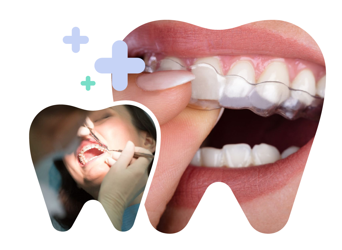 Clear Aligner Orthodontics in Vietnam