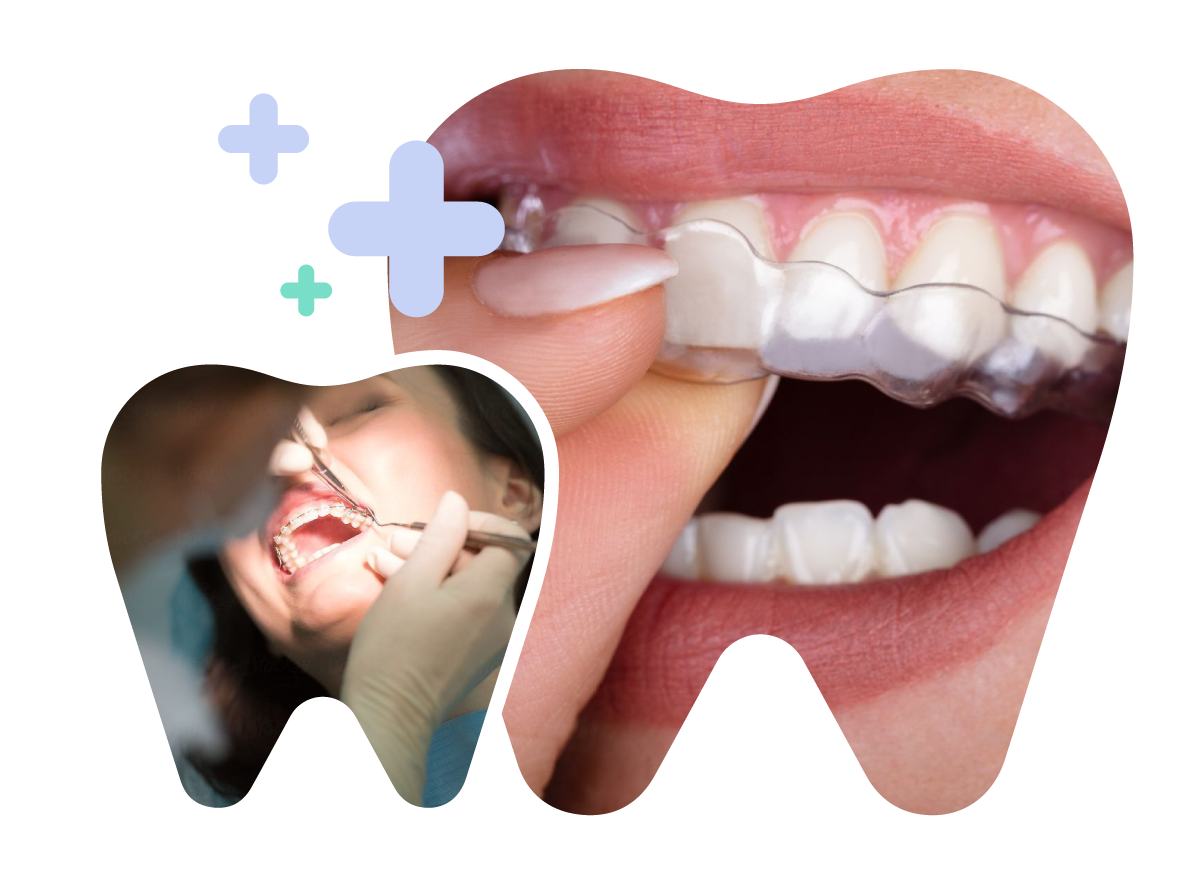 Clear Braces in Vietnam. Clear Braces in Vietnam. Clear Braces in Vietnam. Clear Braces in Vietnam