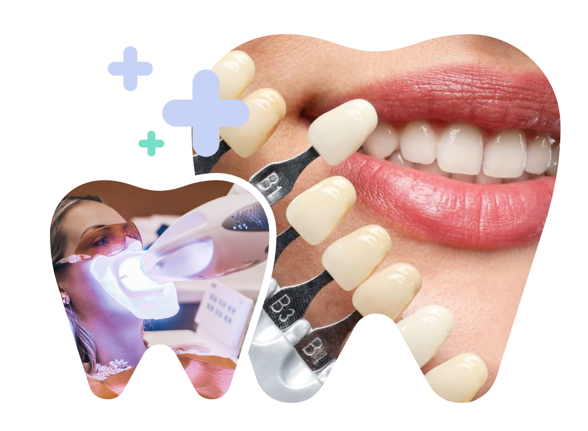 Poor-Quality Porcelain Crowns in Vietnam. Poor-Quality Porcelain Crowns in Vietnam. Poor-Quality Porcelain Crowns in Vietnam