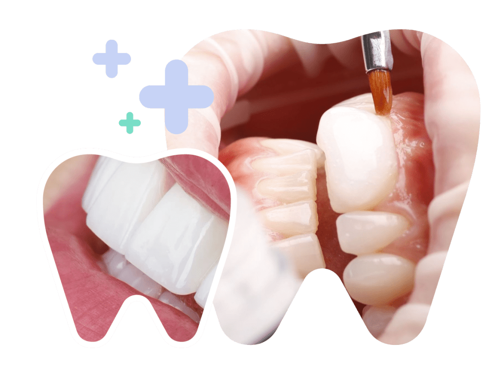 Chipped Tooth in Vietnam