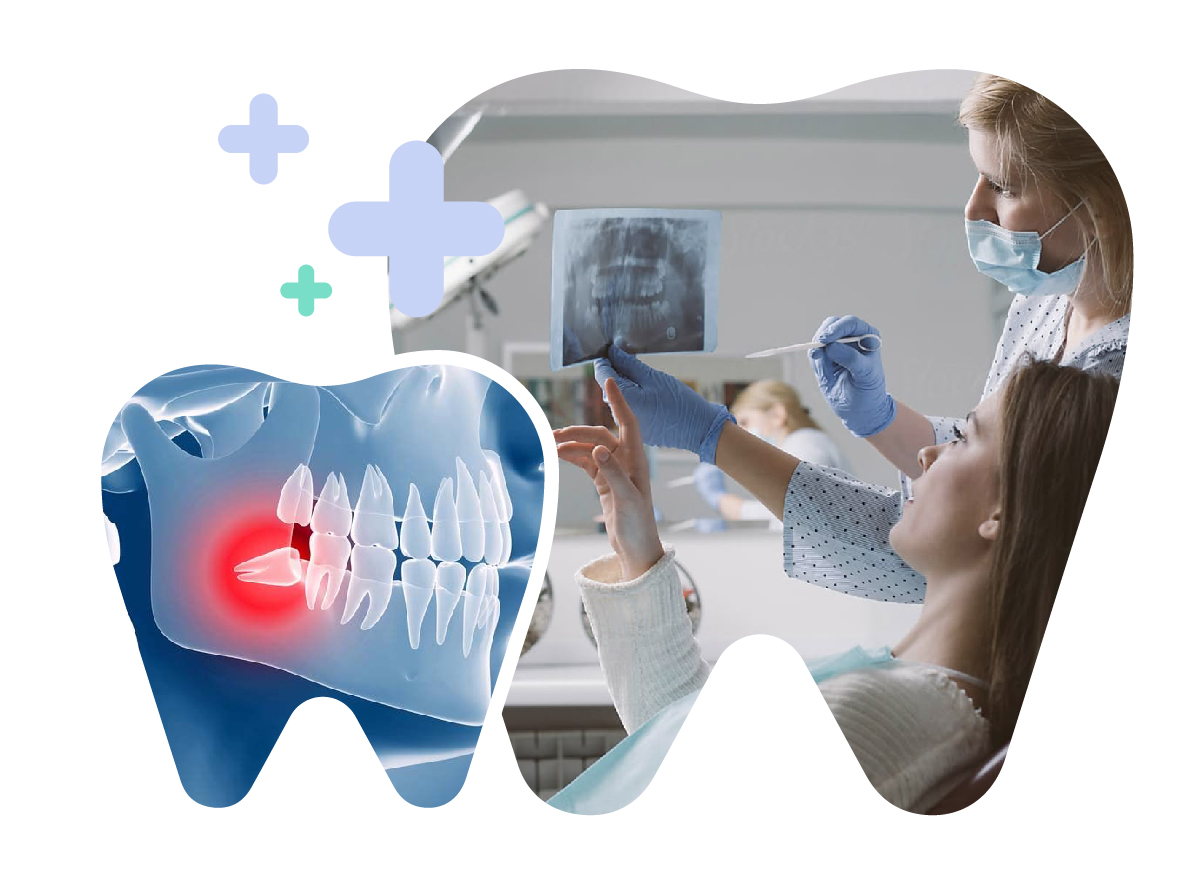 Răng khôn bị lợi trùm