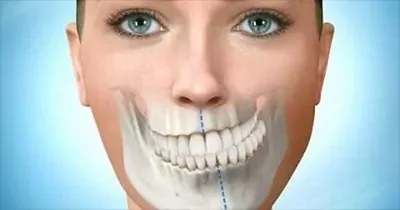 Can Braces Change Facial Appearance in Vietnam?
