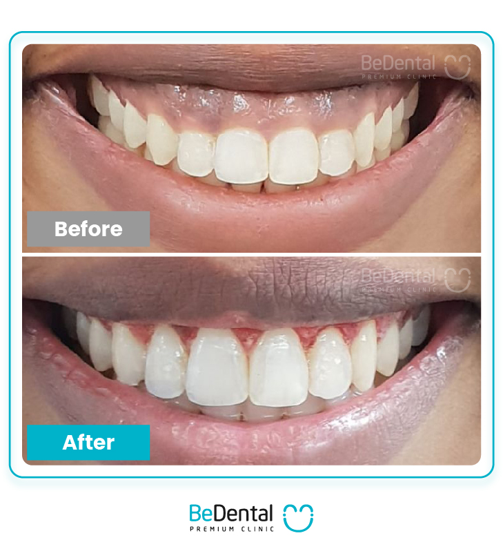 15+ Popular Treatments for Stained Teeth in Vietnam 3 cuoiholoi 106