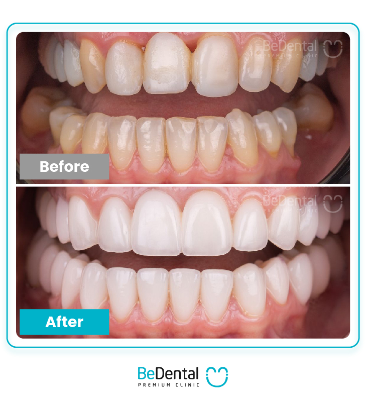 TẨY TRẮNG RĂNG VỀ BỊ Ê BUỐT. TẨY TRẮNG RĂNG VỀ BỊ Ê BUỐT