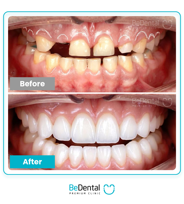 Permanent dental implant price in Vietnam