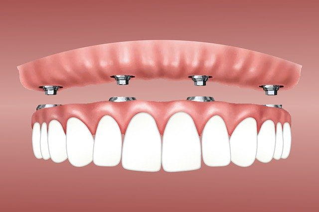 Full-Mouth Porcelain Crowns in Vietnam: The Gold Standard of Dental Tourism 4 dental implant cost 1