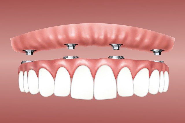 dental implant cost