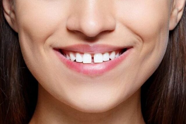 Diastema in Vietnam. Diastema in Vietnam. Diastema in Vietnam. Diastema in Vietnam. Diastema in Vietnam