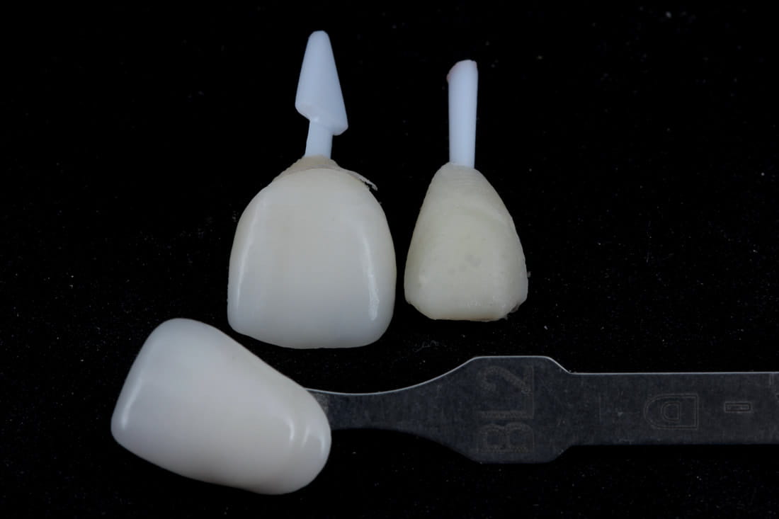 Are Porcelain Crowns Good in Vietnam? 5+ things You Need to Know Before Getting 3 Are Porcelain Crowns Good in Vietnam?