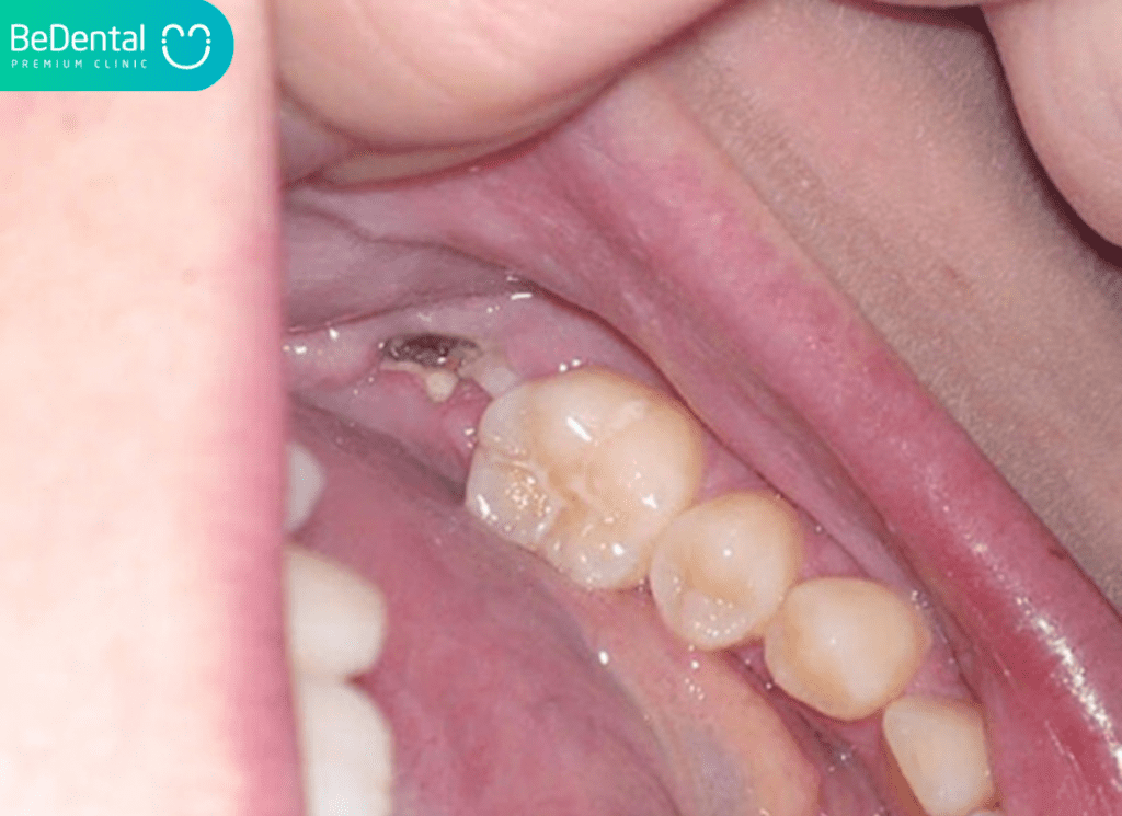 Lỗ hổng sau khi nhổ răng khôn: Quá trình lành thương và cách chăm sóc 2026 3 lỗ hổng sau khi nhổ răng khôn