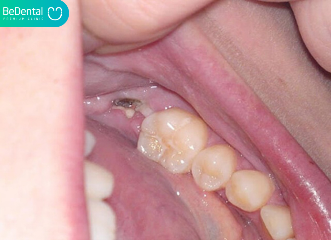 Răng khôn bị sâu vỡ