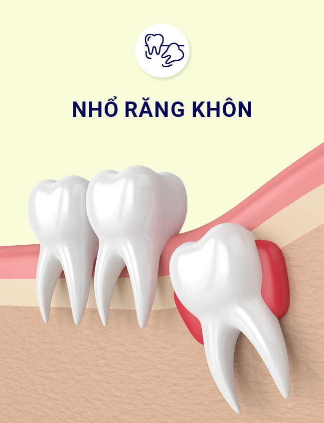sau khi nhổ răng bao lâu thì được đánh răng