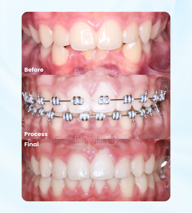 Traditional Braces in Vietnam